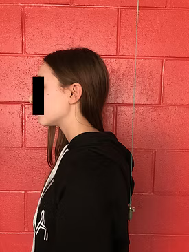 Posture adolescente avant correction